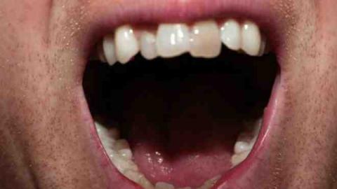 الأسنان المسوسة قد تؤثر على أداء لاعب كرة القدم